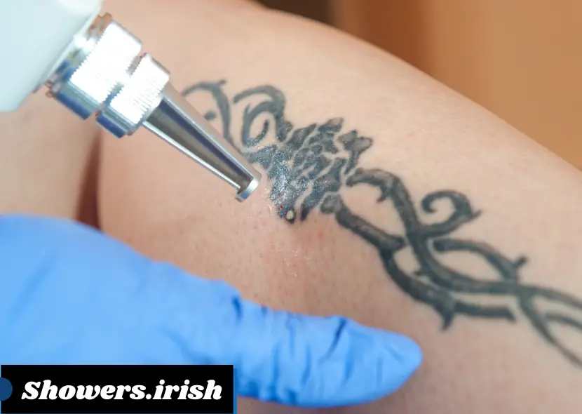 How Long After Laser Tattoo Removal Can You Shower