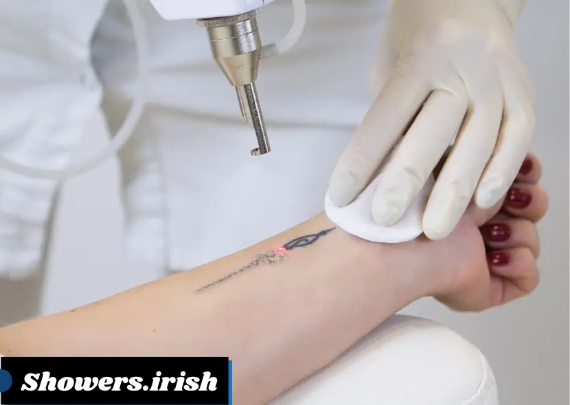 Understanding Laser Tattoo Removal